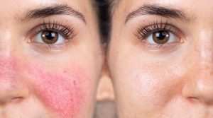 Rosacea Treatment
